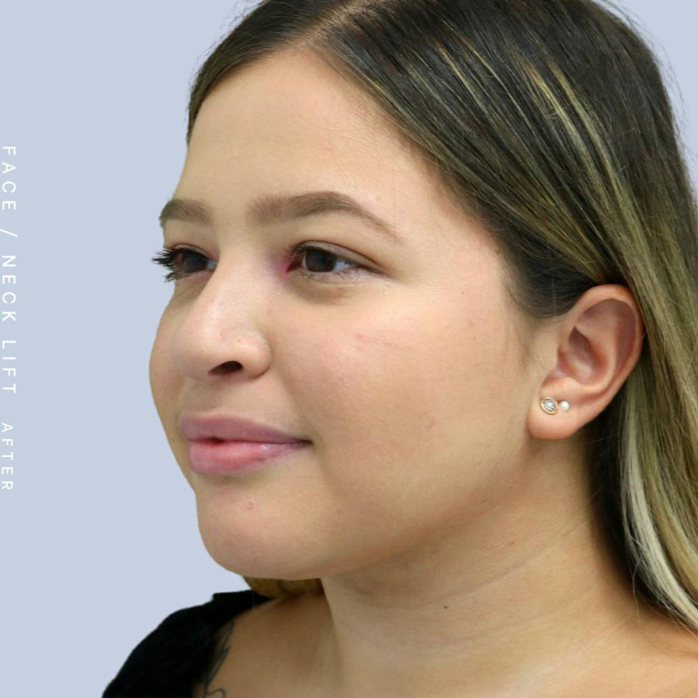 Face & Neck Before & After Gallery - Patient 108707434 - Image 4
