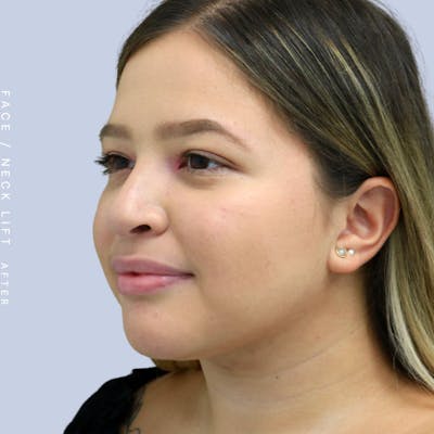 Face & Neck Before & After Gallery - Patient 108707434 - Image 4