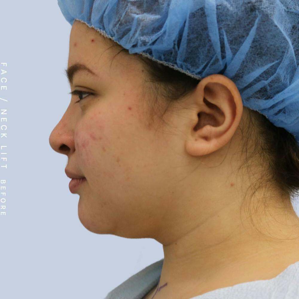 Face & Neck Before & After Gallery - Patient 108707434 - Image 5