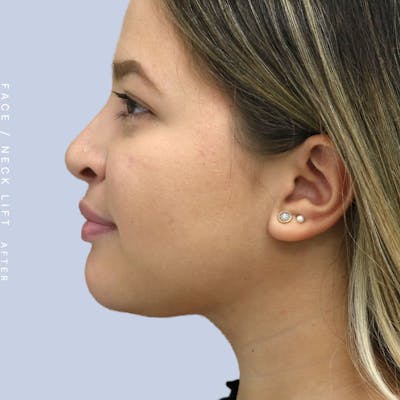 Face & Neck Before & After Gallery - Patient 108707434 - Image 6