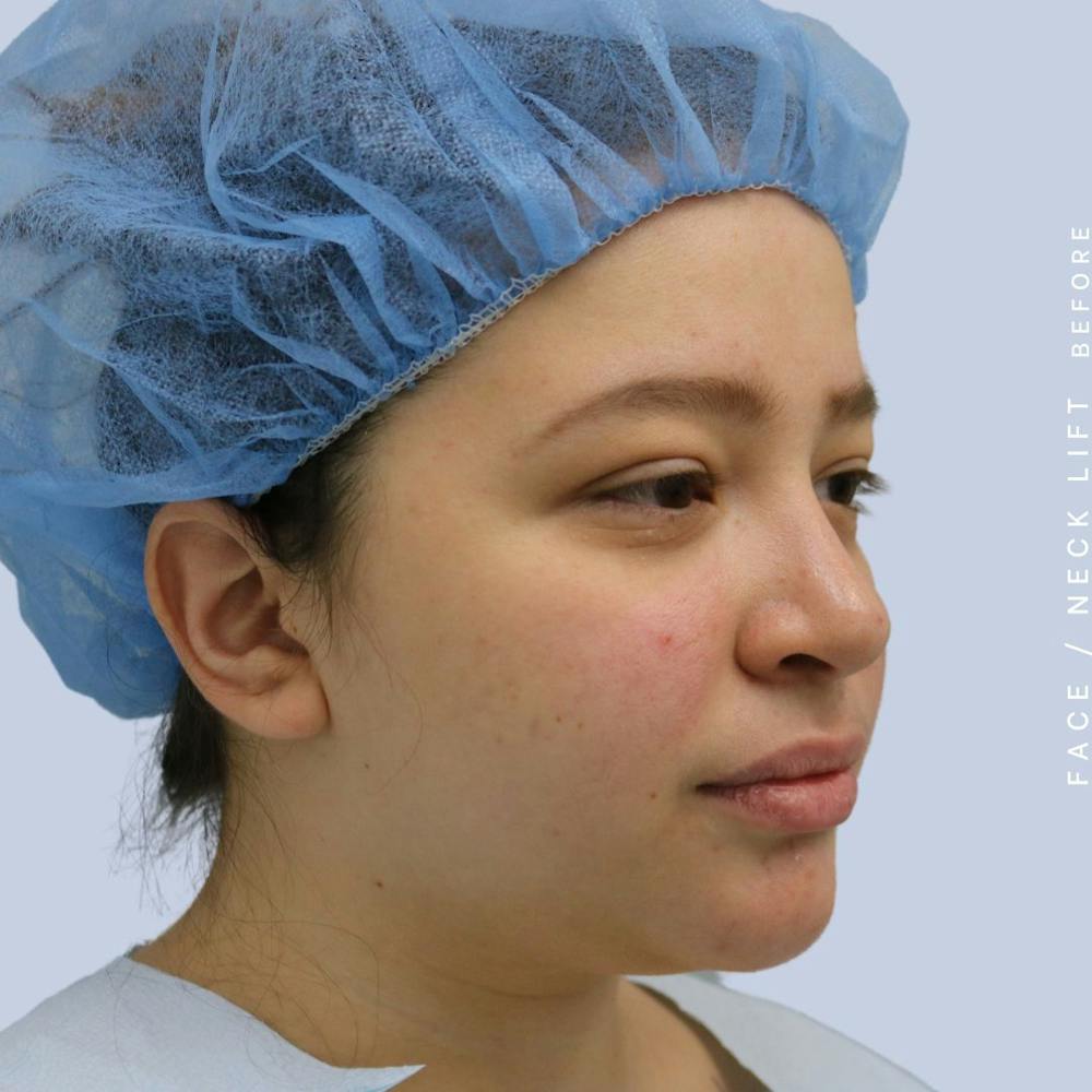 Face & Neck Before & After Gallery - Patient 108707434 - Image 7