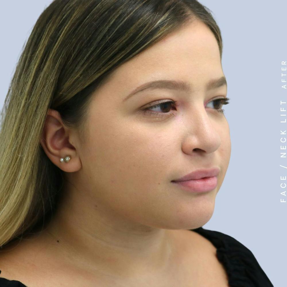 Face & Neck Before & After Gallery - Patient 108707434 - Image 8
