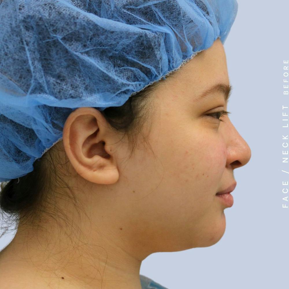 Face & Neck Before & After Gallery - Patient 108707434 - Image 9