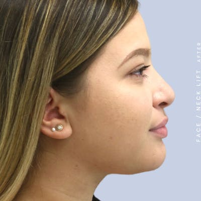 Face & Neck Before & After Gallery - Patient 108707434 - Image 10