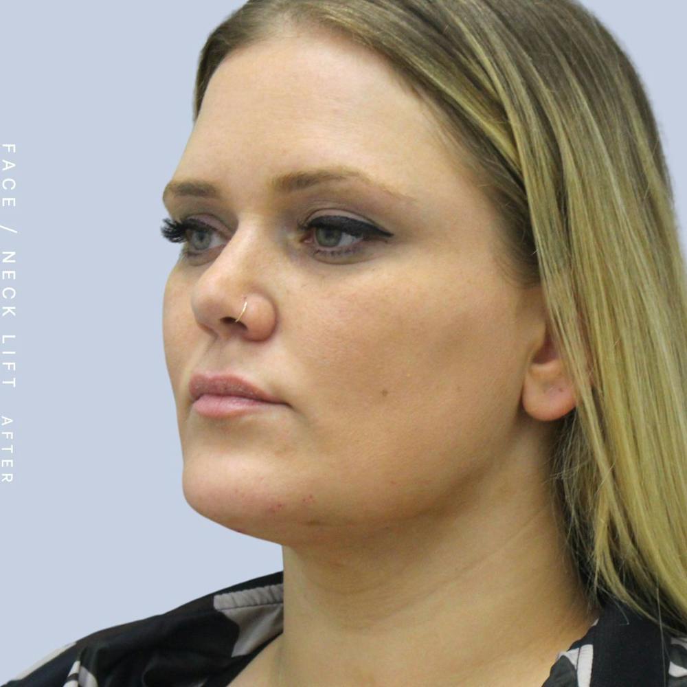 Face & Neck Before & After Gallery - Patient 108707489 - Image 2