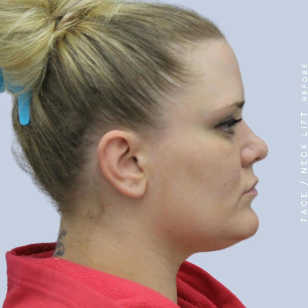 Face & Neck Before & After Gallery - Patient 108707489 - Image 3