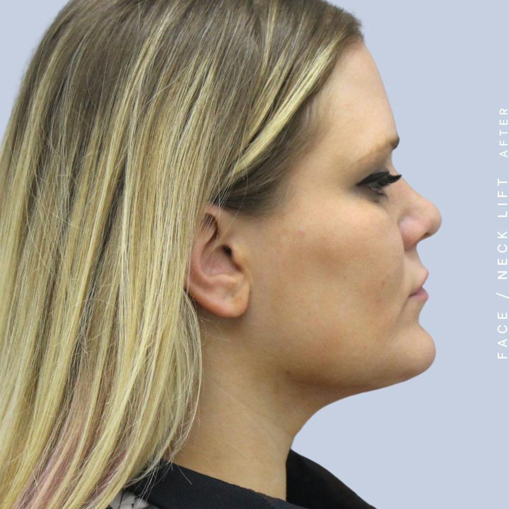 Face & Neck Before & After Gallery - Patient 108707489 - Image 4