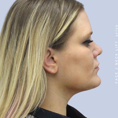 Face & Neck Before & After Gallery - Patient 108707489 - Image 4
