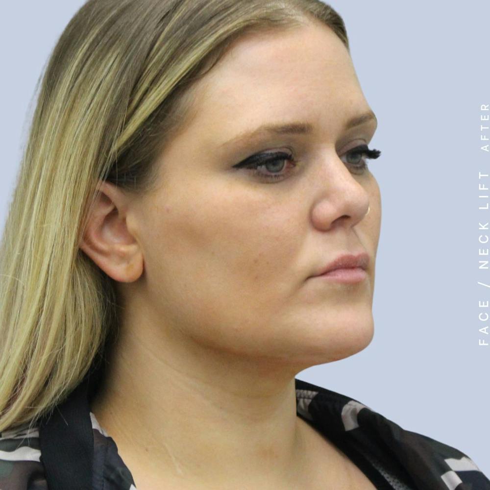 Face & Neck Before & After Gallery - Patient 108707489 - Image 6