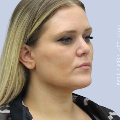 Face & Neck Before & After Gallery - Patient 108707489 - Image 6