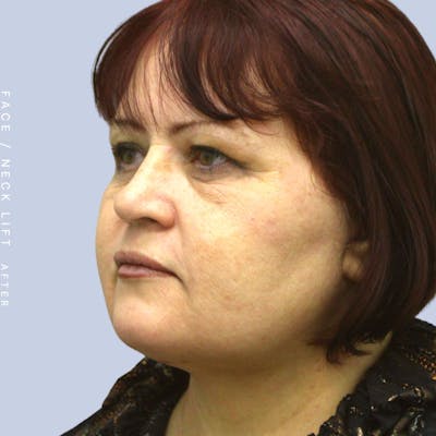 Face & Neck Before & After Gallery - Patient 120897028 - Image 2