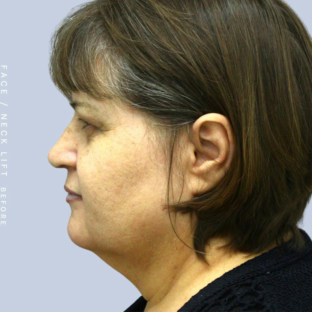 Face & Neck Gallery - Patient 120897028 - Image 3