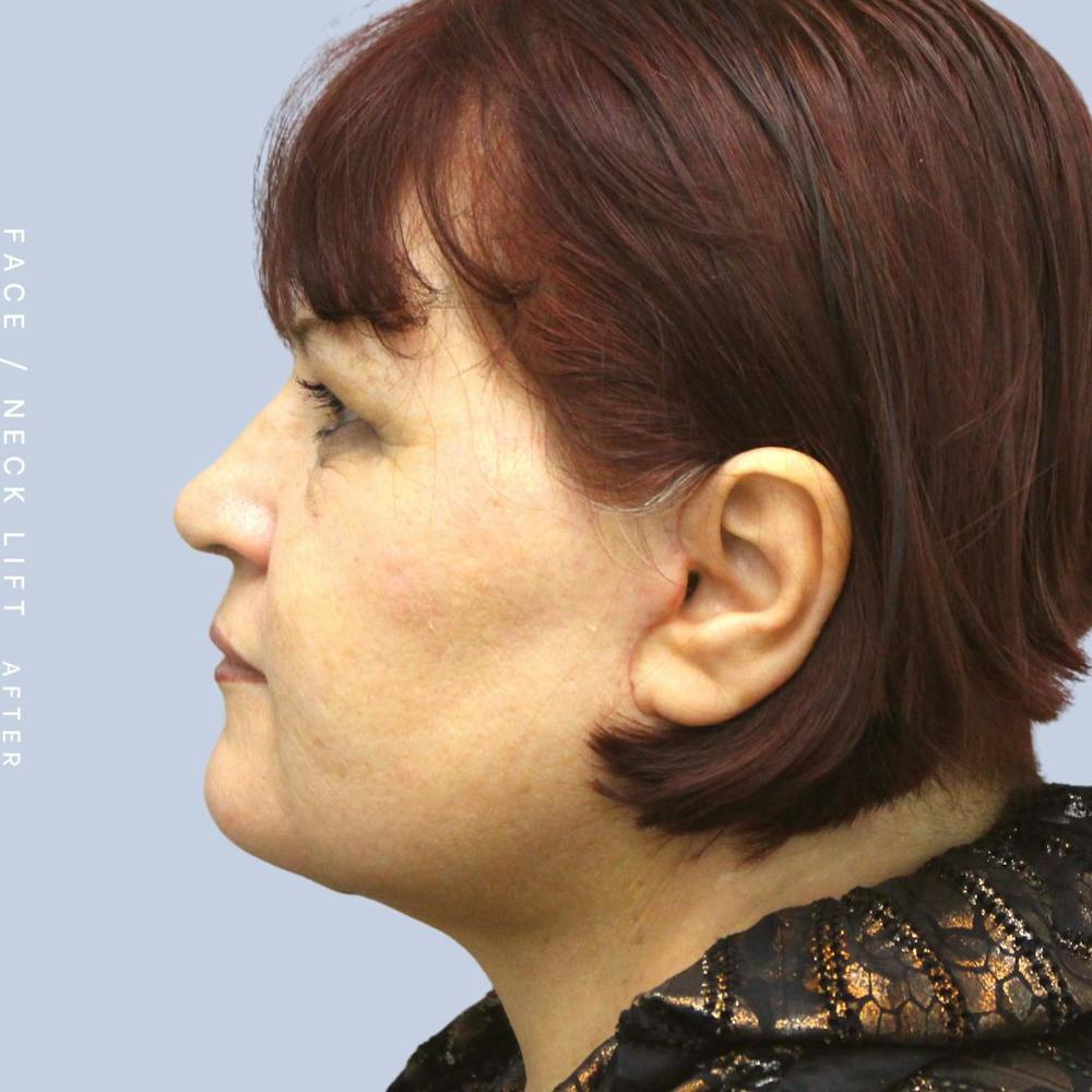 Face & Neck Before & After Gallery - Patient 120897028 - Image 4