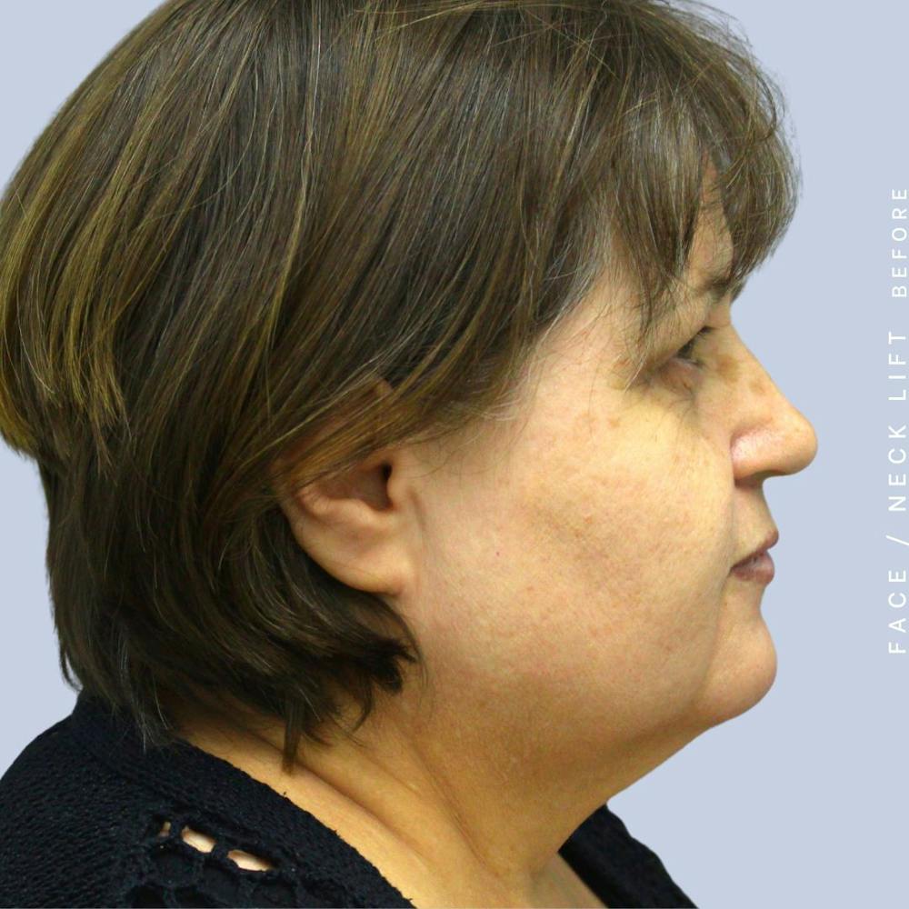 Face & Neck Before & After Gallery - Patient 120897028 - Image 5
