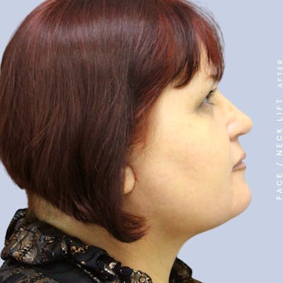 Face & Neck Before & After Gallery - Patient 120897028 - Image 6