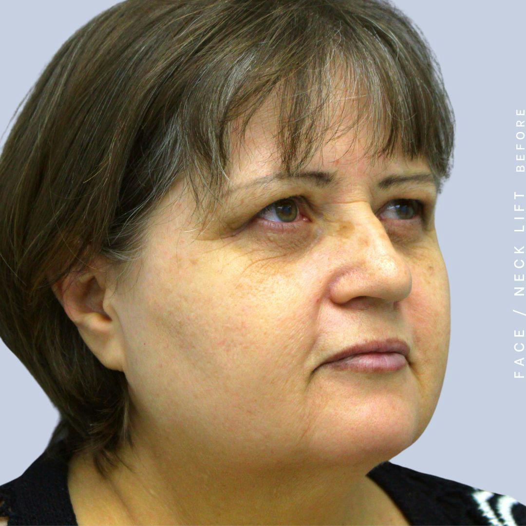Face & Neck Before & After Gallery - Patient 120897028 - Image 7