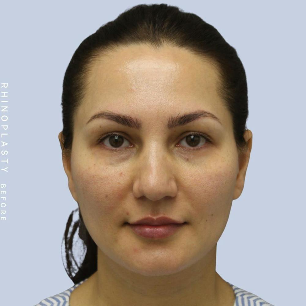 Nose Before & After Gallery - Patient 108743561 - Image 1