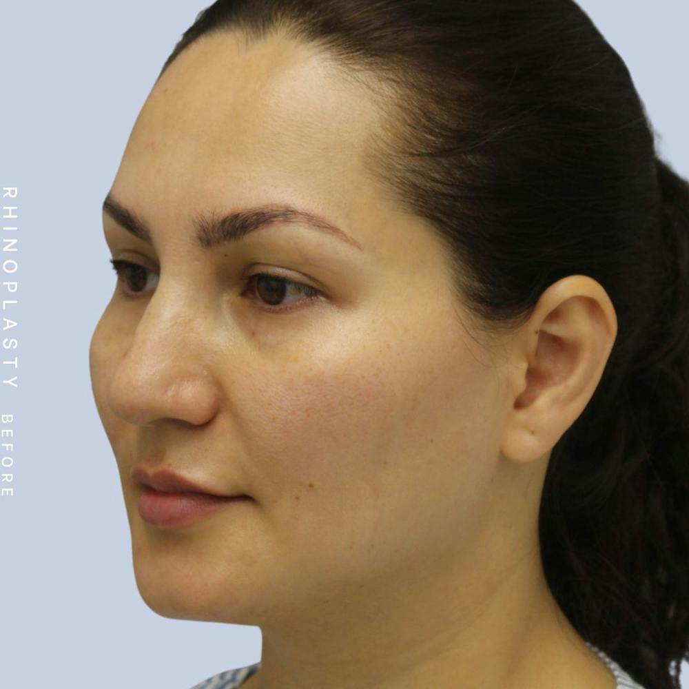Nose Before & After Gallery - Patient 108743561 - Image 3