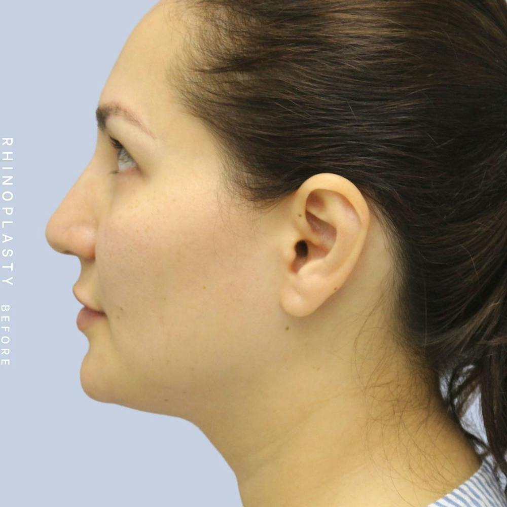 Nose Before & After Gallery - Patient 108743561 - Image 5