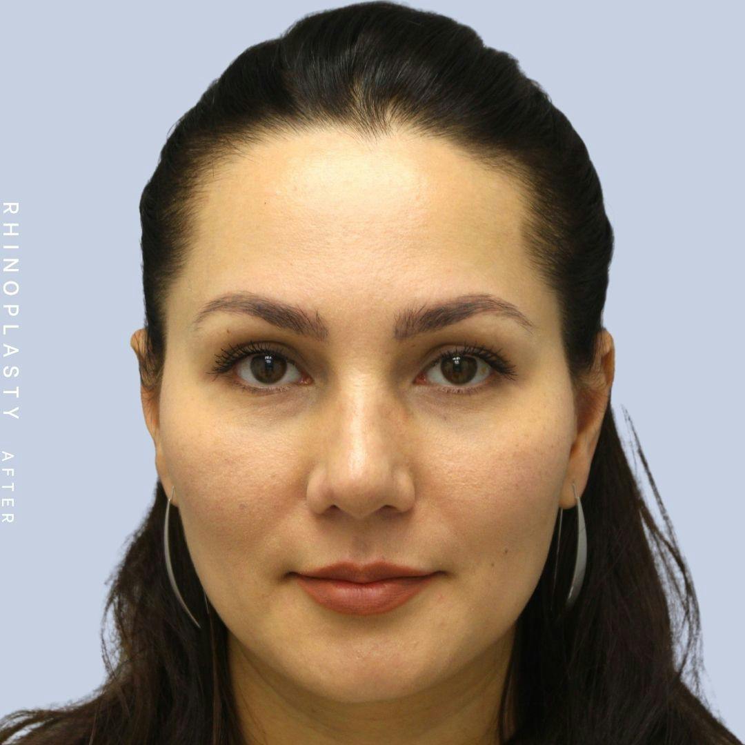 Nose Before & After Gallery - Patient 108743561 - Image 2