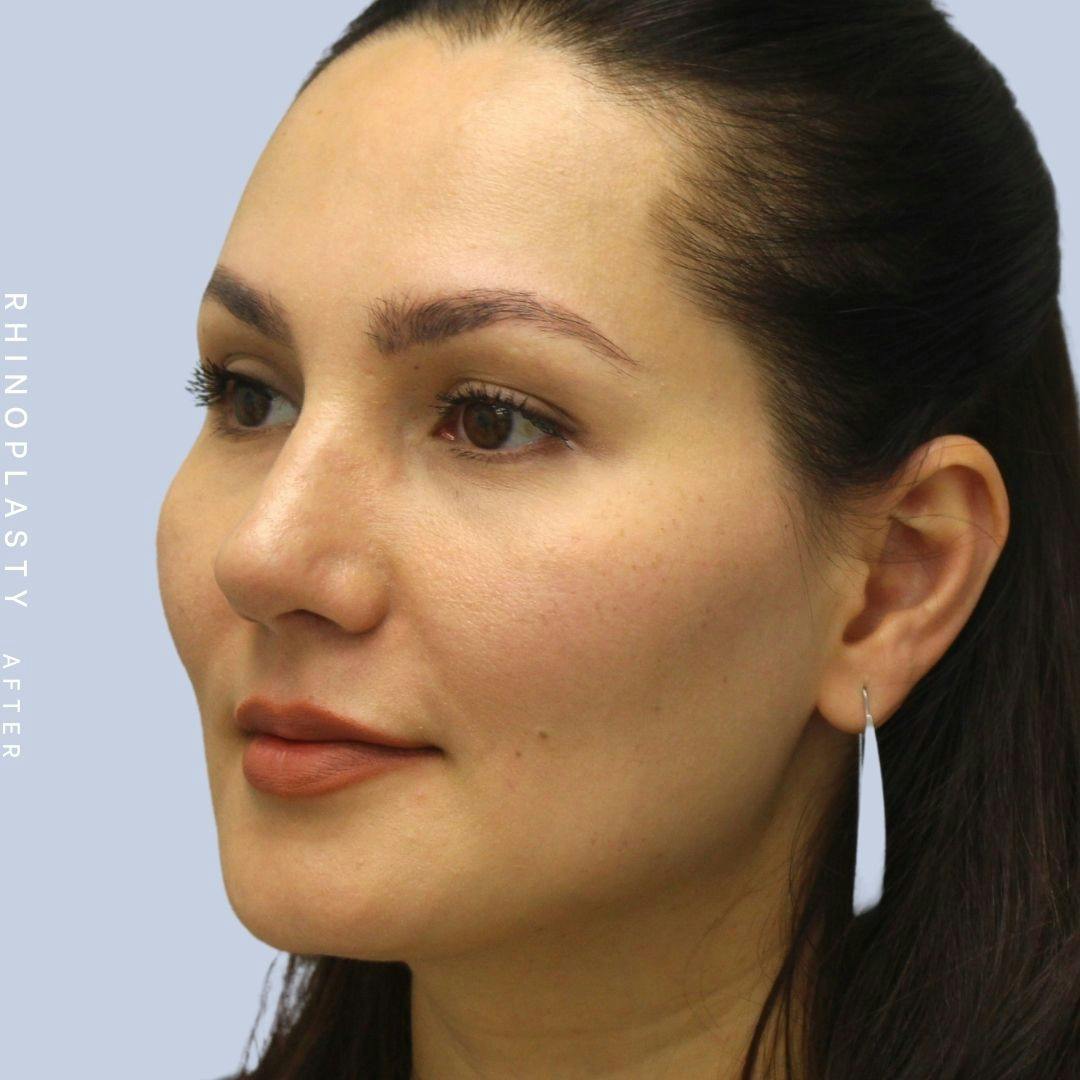 Nose Before & After Gallery - Patient 108743561 - Image 4