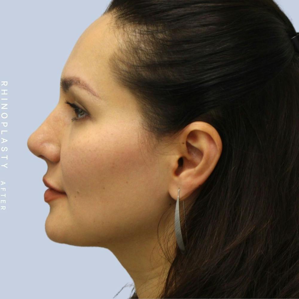 Nose Before & After Gallery - Patient 108743561 - Image 6