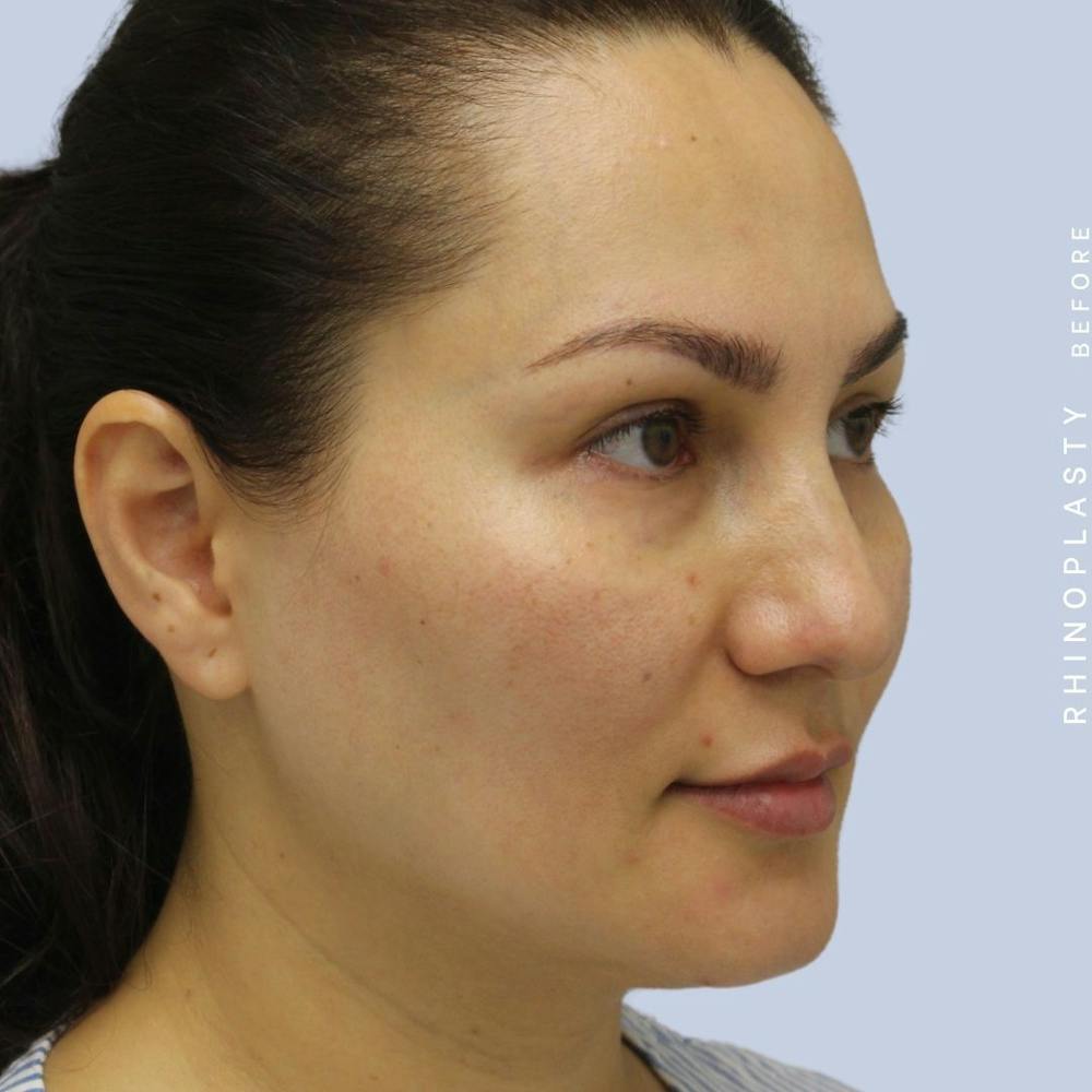 Nose Before & After Gallery - Patient 108743561 - Image 7