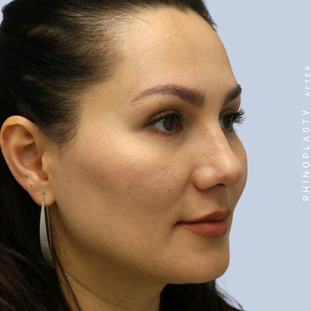 Nose Before & After Gallery - Patient 108743561 - Image 8