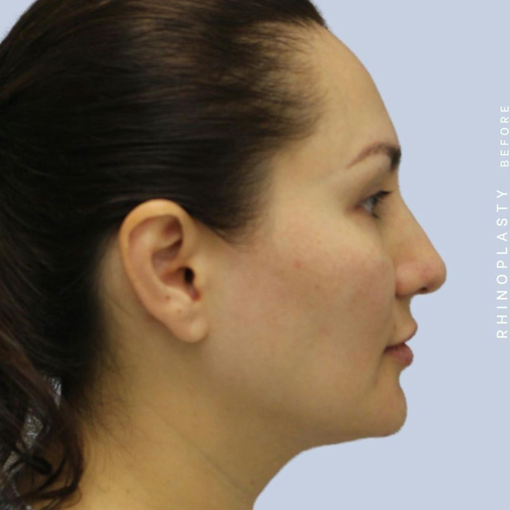 Nose Before & After Gallery - Patient 108743561 - Image 9