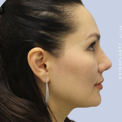 Nose Before & After Gallery - Patient 108743561 - Image 10