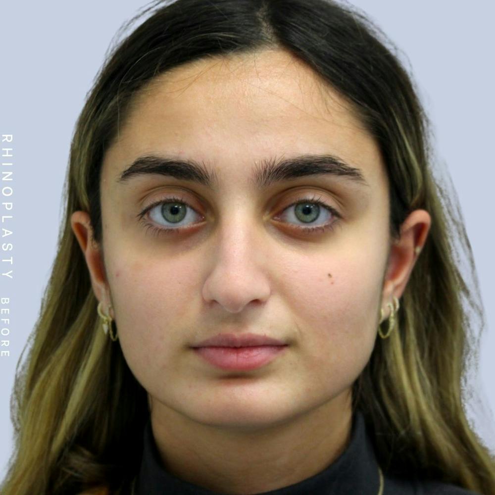 Nose Before & After Gallery - Patient 108743562 - Image 2