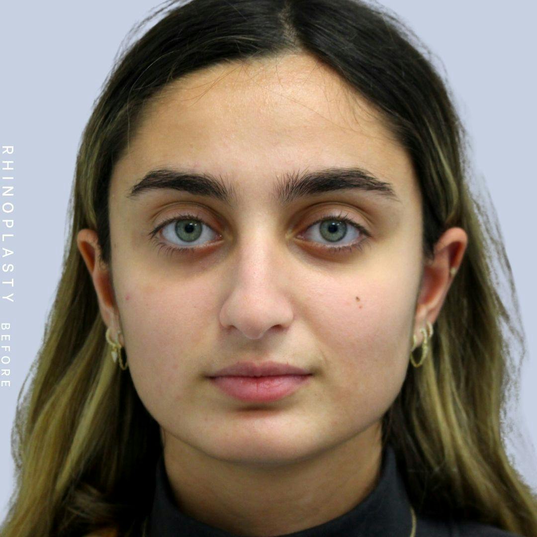 Nose Before & After Gallery - Patient 108743562 - Image 2