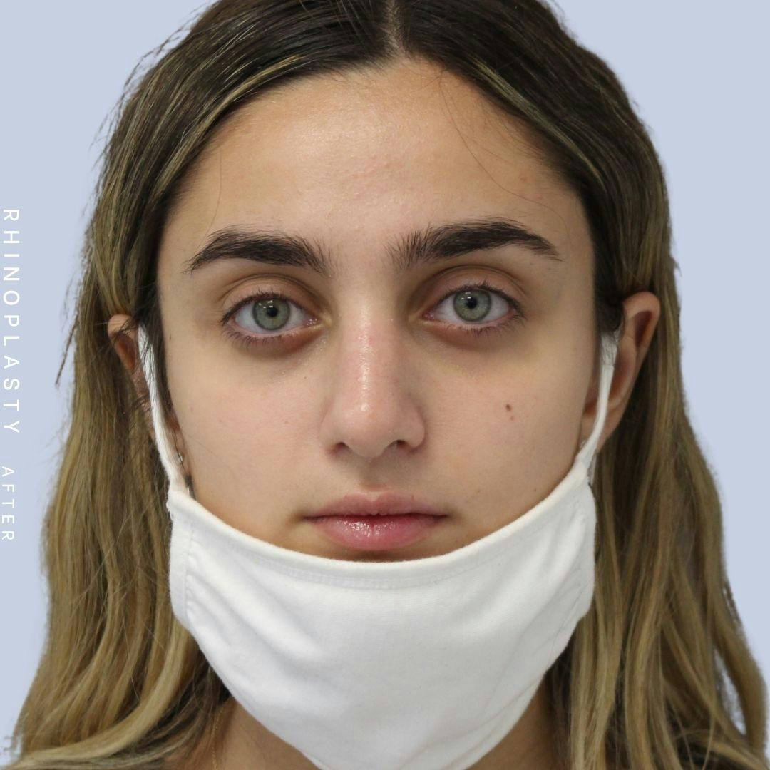 Nose Before & After Gallery - Patient 108743562 - Image 1