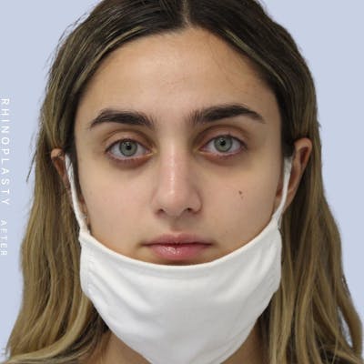Nose Before & After Gallery - Patient 108743562 - Image 1