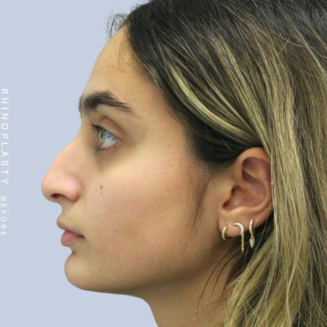 Nose Before & After Gallery - Patient 108743562 - Image 2