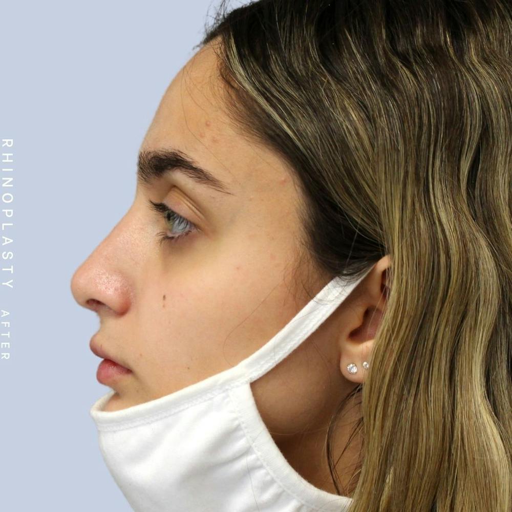 Nose Before & After Gallery - Patient 108743562 - Image 3