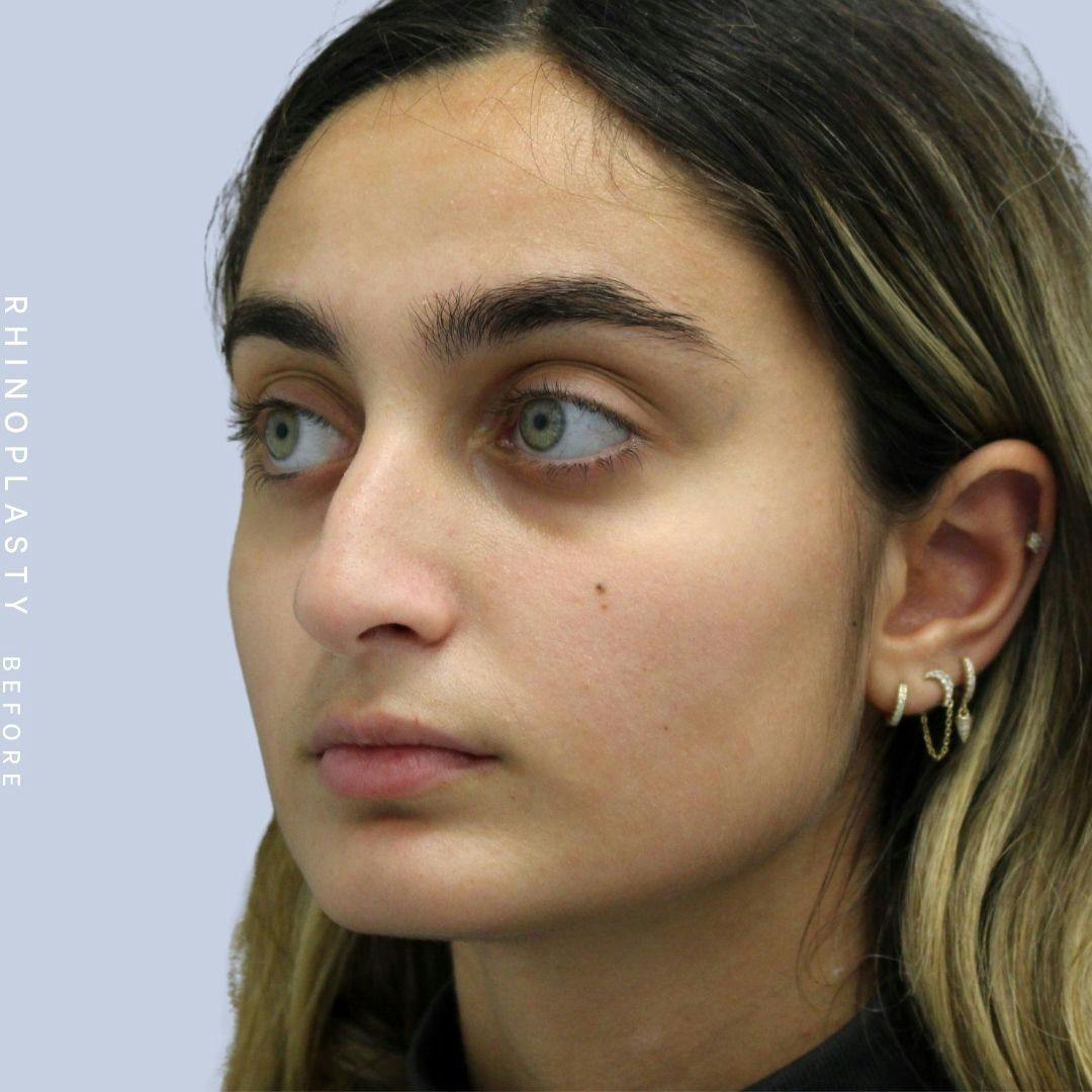 Nose Before & After Gallery - Patient 108743562 - Image 4