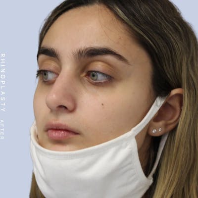 Nose Before & After Gallery - Patient 108743562 - Image 6