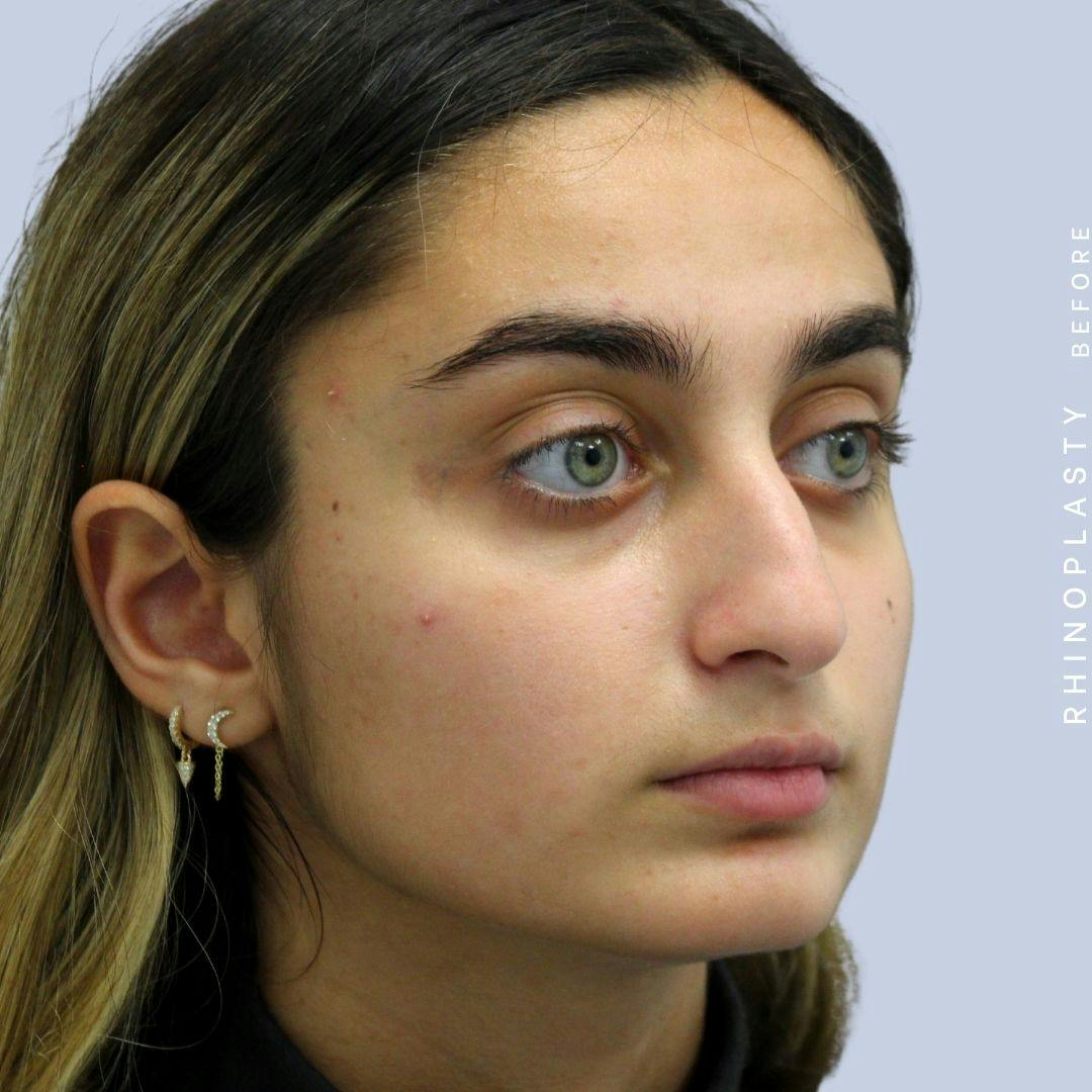 Nose Before & After Gallery - Patient 108743562 - Image 6