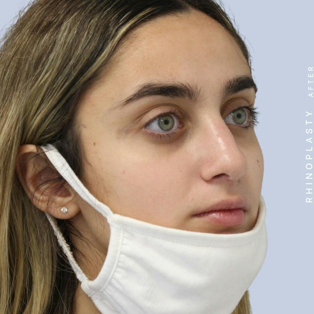 Nose Before & After Gallery - Patient 108743562 - Image 7