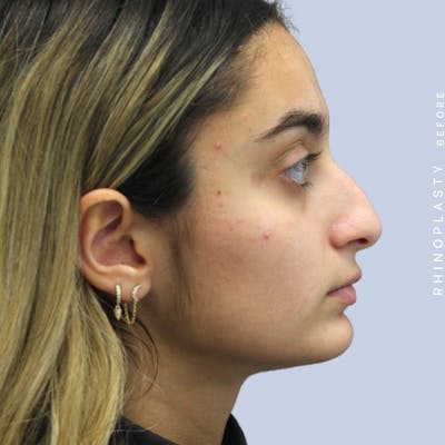 Nose Before & After Gallery - Patient 108743562 - Image 8