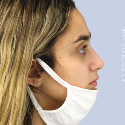 Nose Before & After Gallery - Patient 108743562 - Image 10