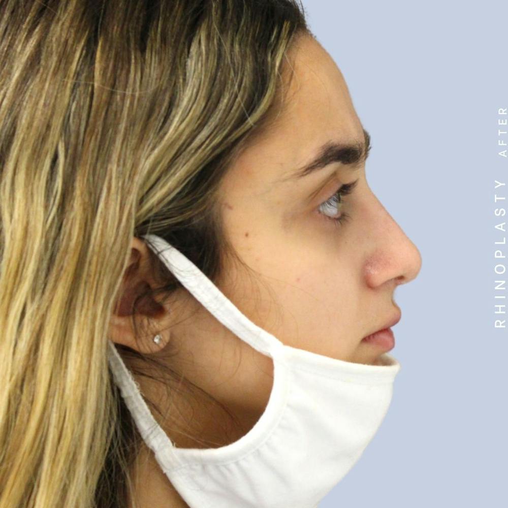 Nose Before & After Gallery - Patient 108743562 - Image 9
