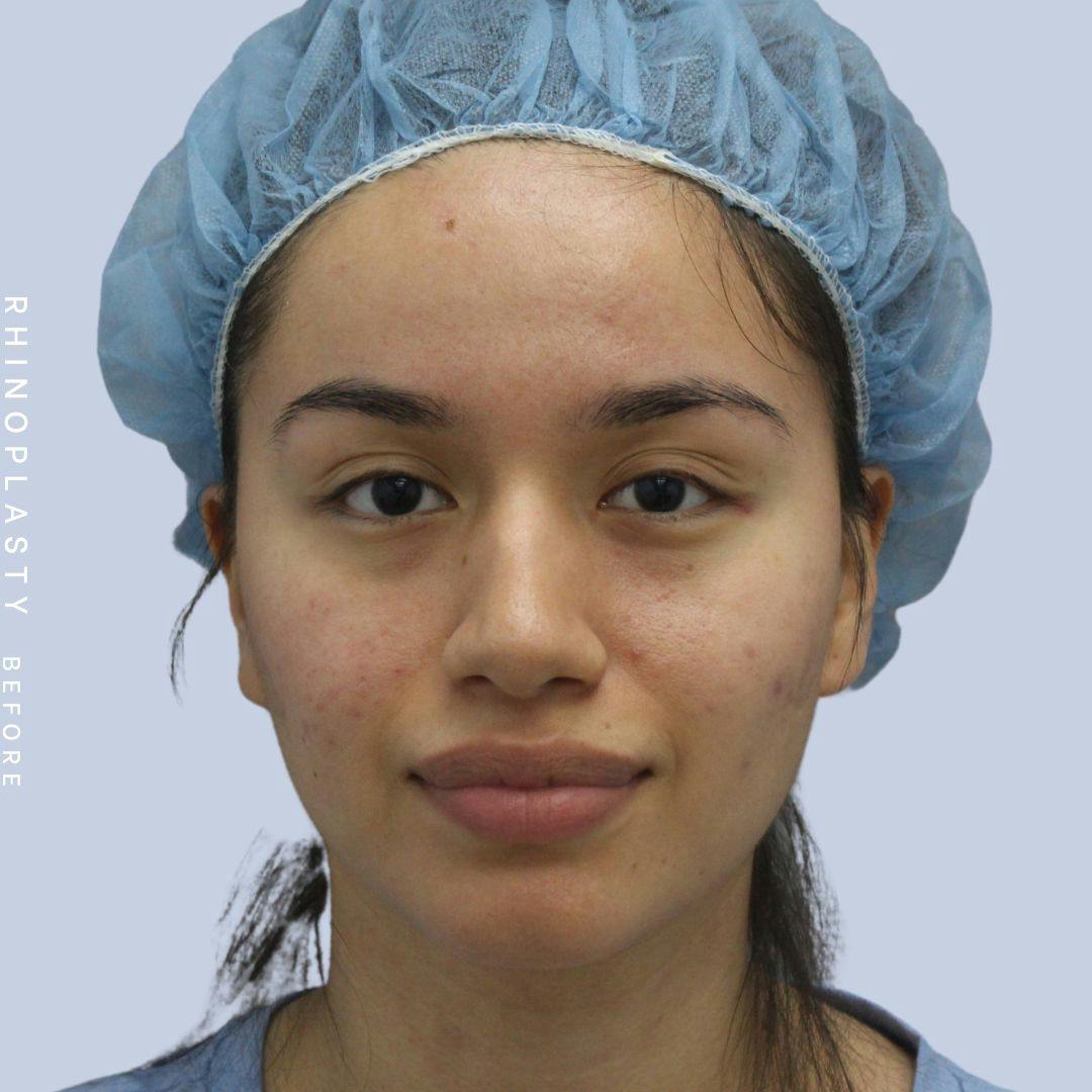 Nose Before & After Gallery - Patient 120868135 - Image 1