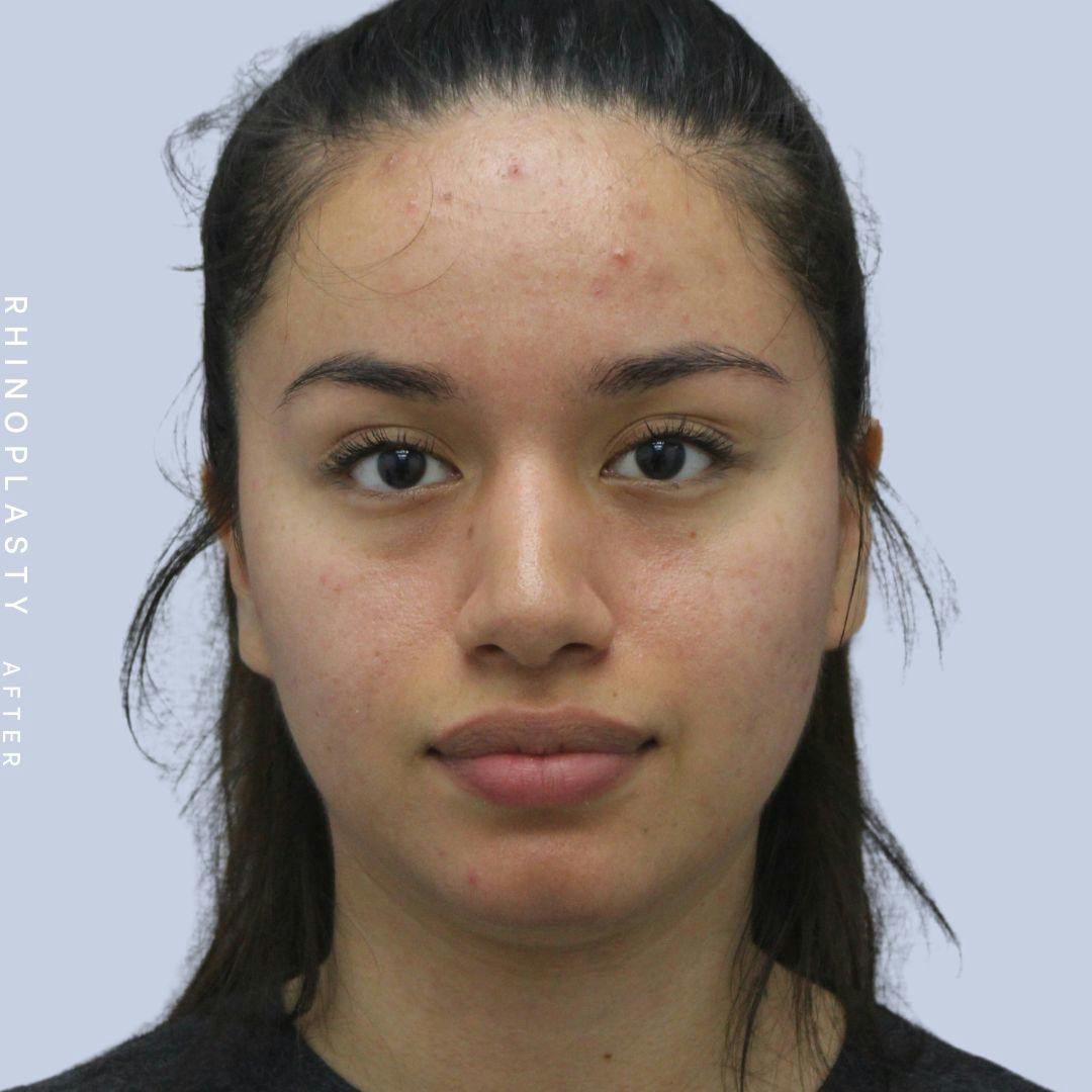 Nose Before & After Gallery - Patient 120868135 - Image 2