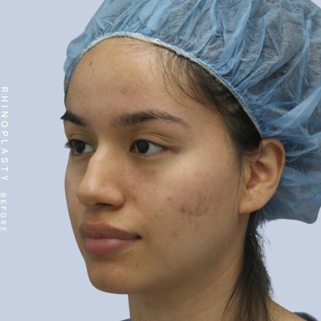 Nose Before & After Gallery - Patient 120868135 - Image 3