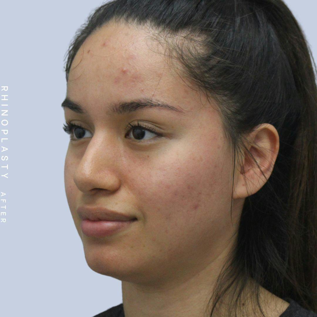 Nose Before & After Gallery - Patient 120868135 - Image 4