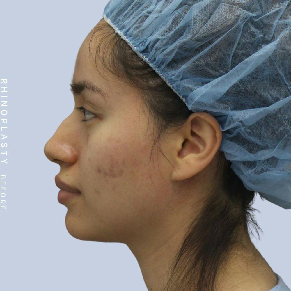 Nose Before & After Gallery - Patient 120868135 - Image 5