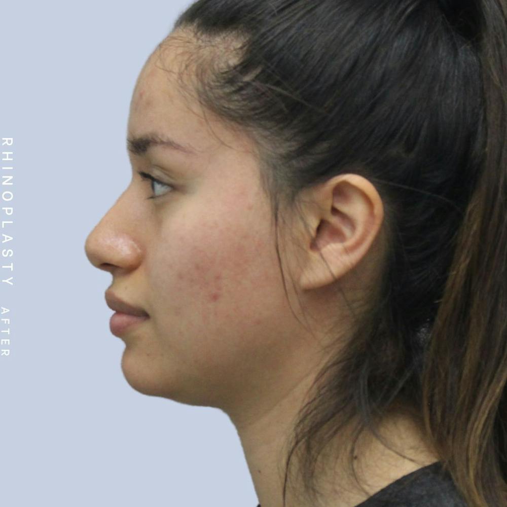 Nose Before & After Gallery - Patient 120868135 - Image 6