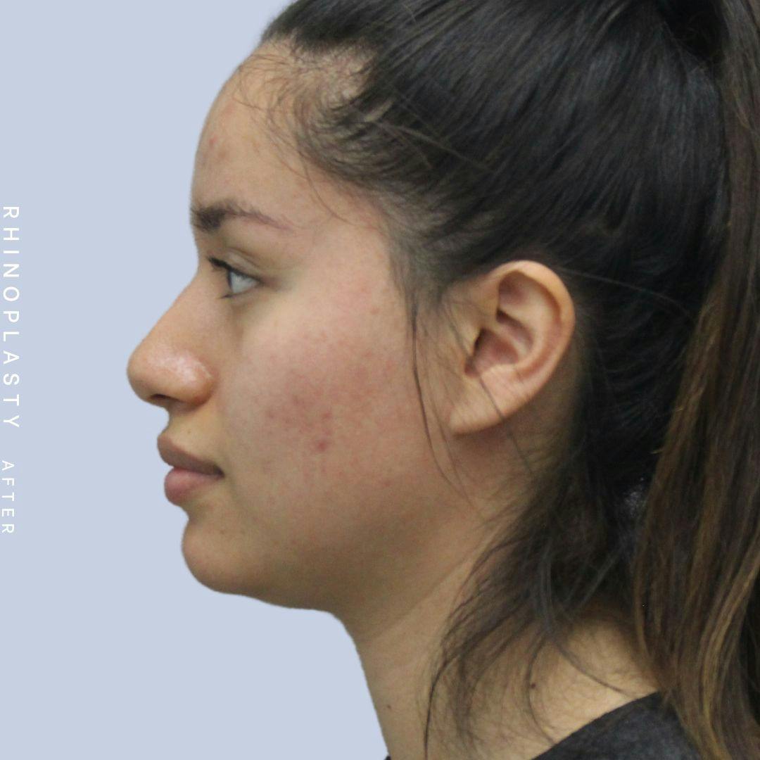 Nose Before & After Gallery - Patient 120868135 - Image 6